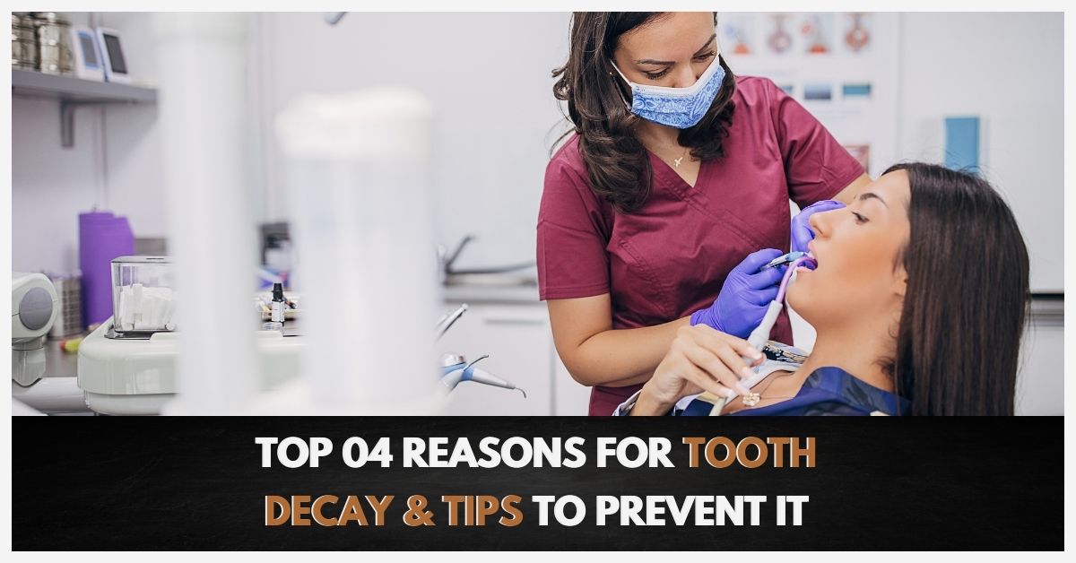 Top 04 Reasons For Tooth Decay & Tips To Prevent It