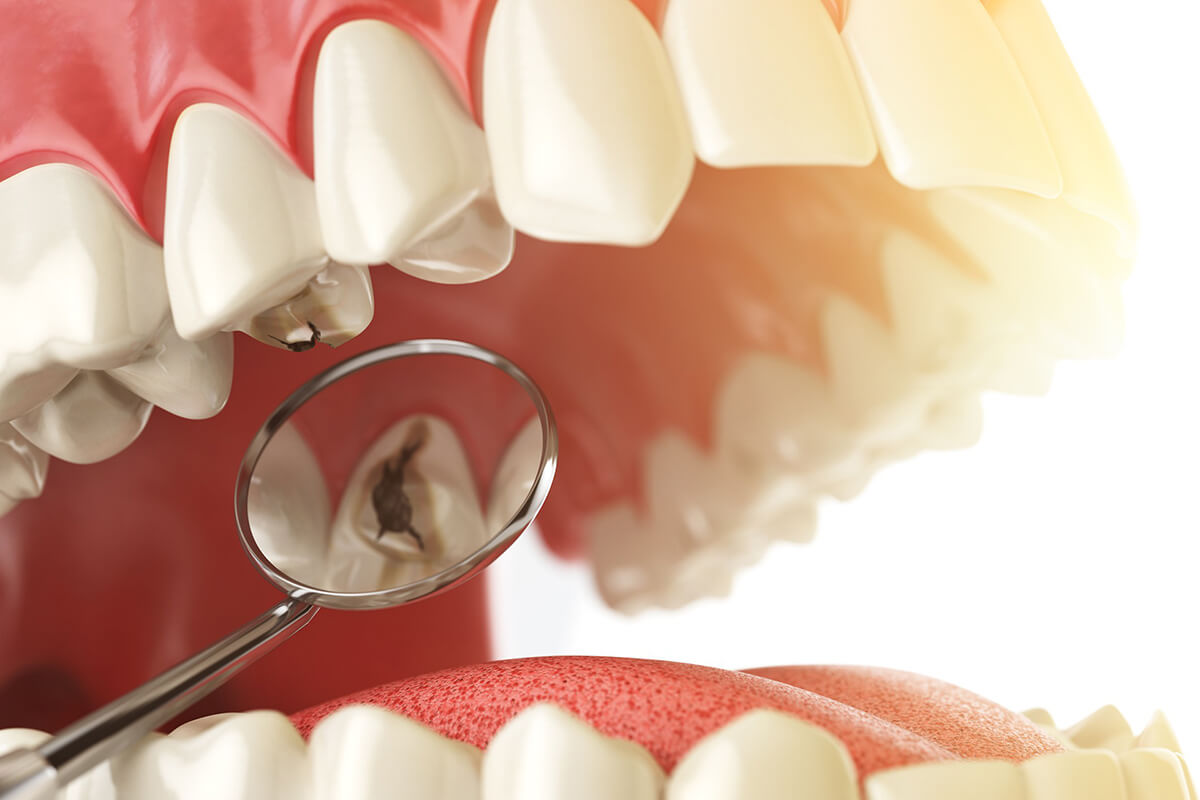 Oral Health Putting You at Risk for Cavities
